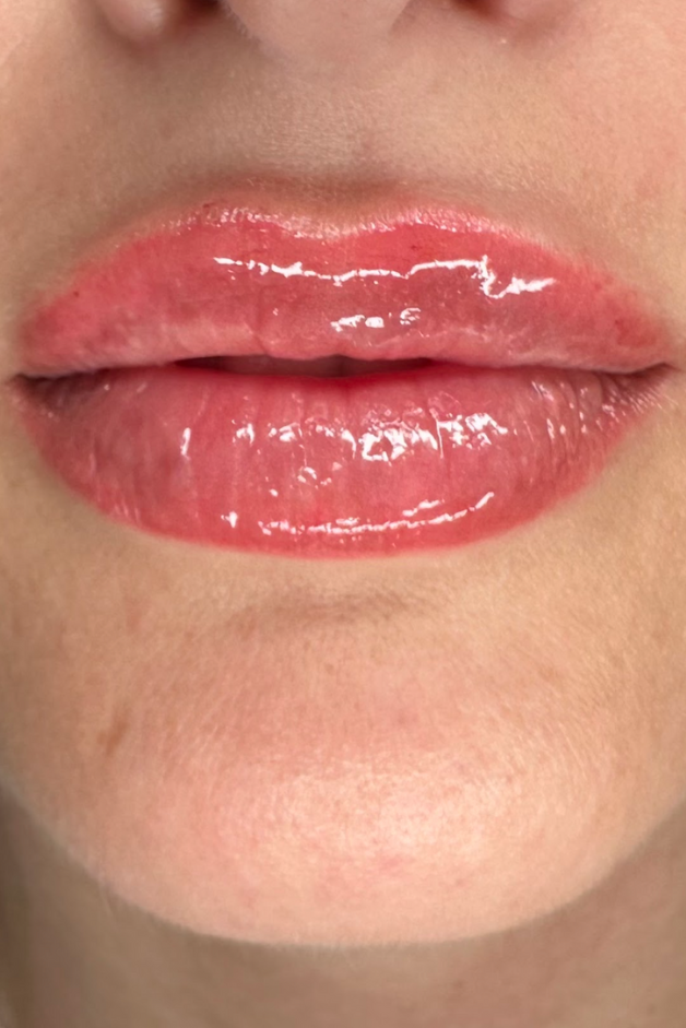 lip injection aftercare lip injection boca raton