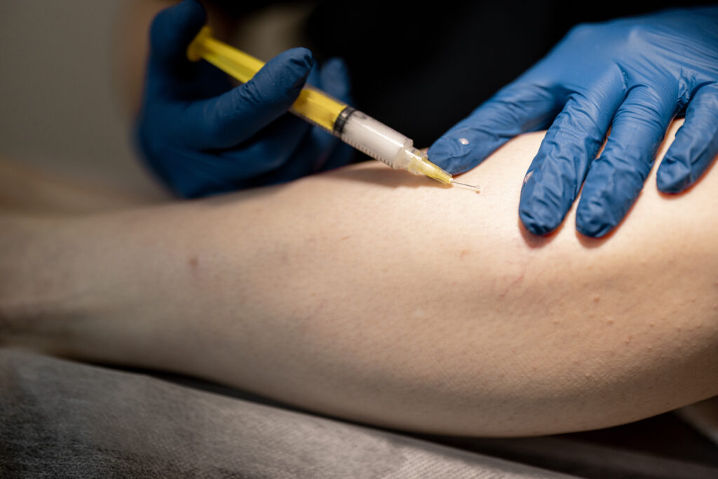 Sclerotherapy boca raton fl