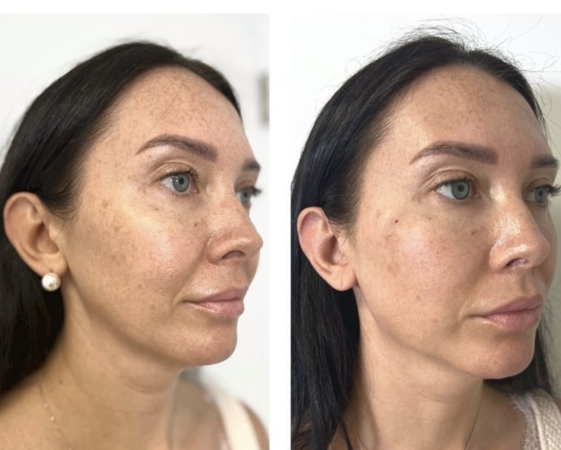 dermal filler boca raton