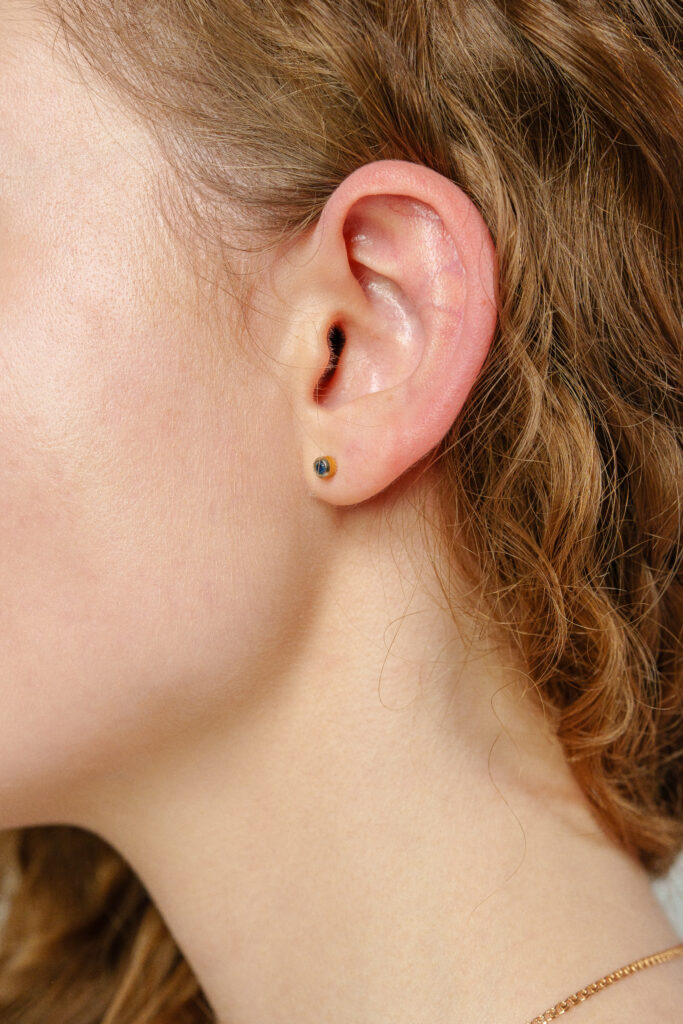 ear lobe filler boca raton