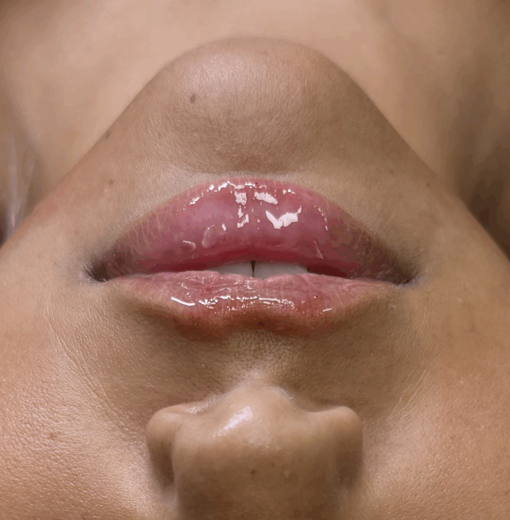 lip filler boca raton