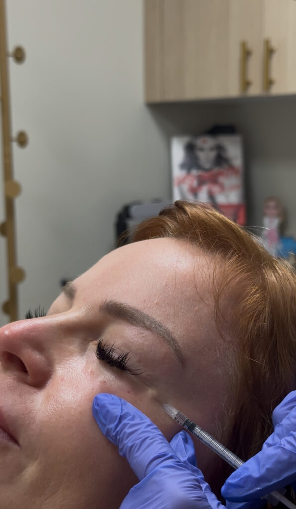 Crows Feet Tox boca raton