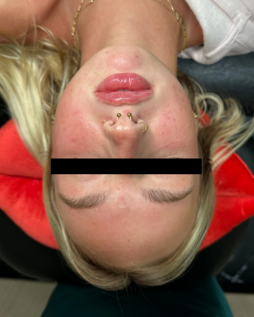 lip filler boca raton