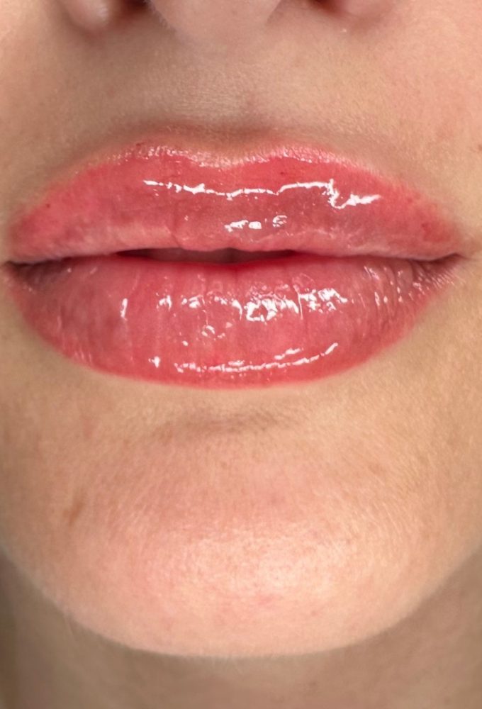 Lip Filler 1/2 Syringe - 15